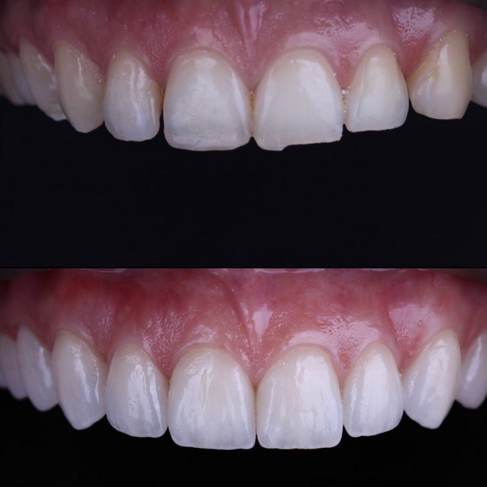 Виниры за 17 600 сом